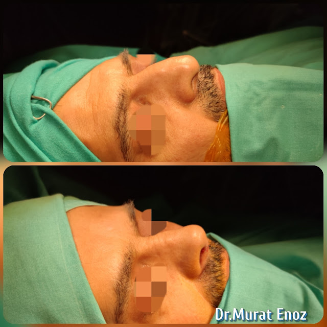 Open Technique Nose Tip Lifting,Tip Drooping After Septoplasty Operation,Nasal Tip Ptosis After Septoplasty,