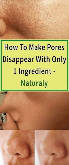 The Most Effective Method To Make Pores Disappear With Only 1 Ingredient – Naturally!