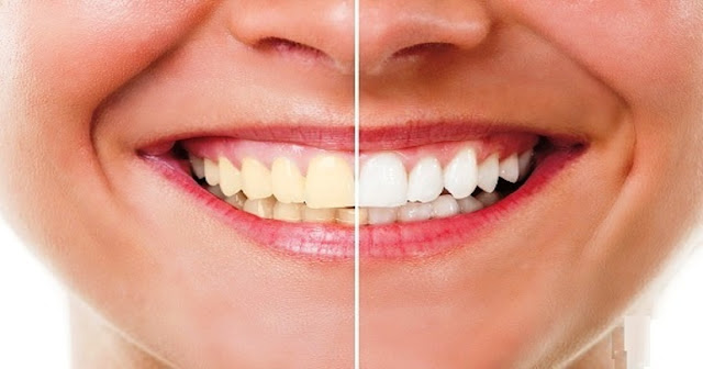 3 façons naturelles de se blanchir les dents