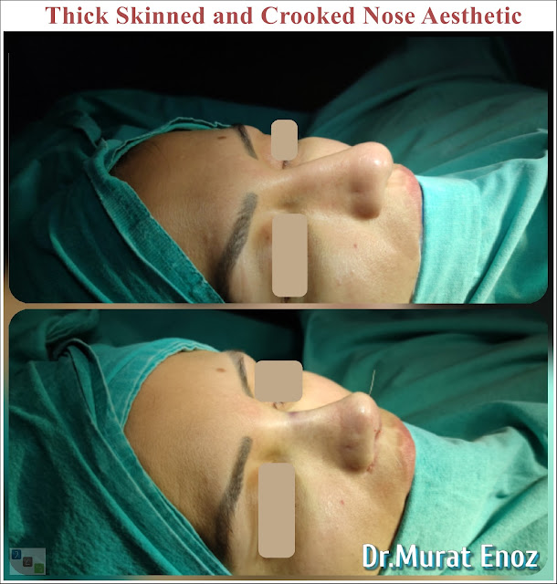 Crooked Nose Aesthetic Surgery in Istanbul,Twisted Nose Rhinoplasty,
