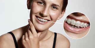 Quy trình niềng răng người lớn-1