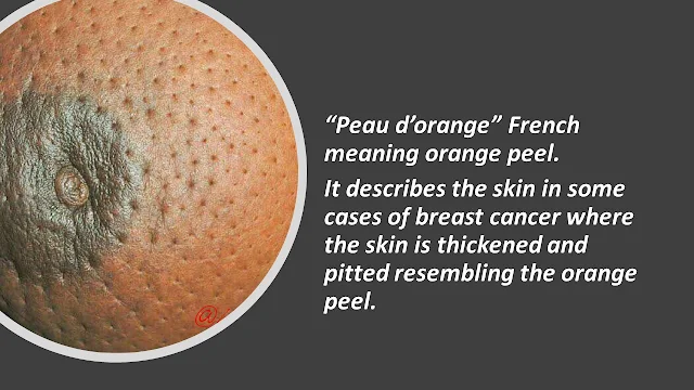 Sometimes the skin of breast may be thickened and pitted and having the texture of an orange peel. A condition known as Peau d'orange.