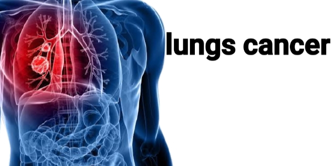 Symptoms of lungs cancer