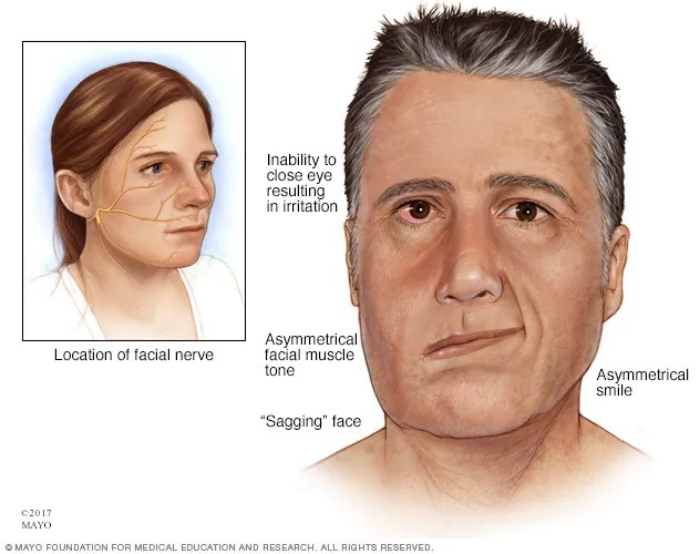 Ramsay Hunt syndrome