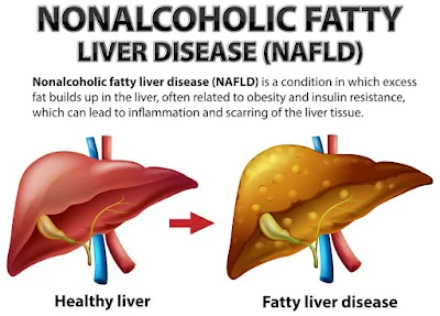 Causes of Nonalcoholic Fatty Liver Disease- healthy bel