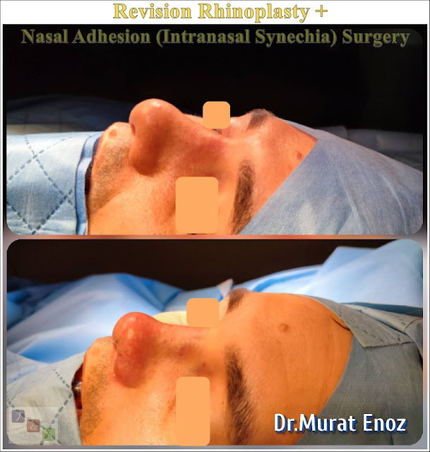 revision rhinoplasty + nasal adhesion removal surgery + septoplasty + nasal bone spur excision