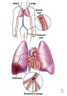 pulmonary embolisms,blood clot on lung,pulmonary embolism treatmentpulmonary embolism birth control,pulmonary embolism smoking