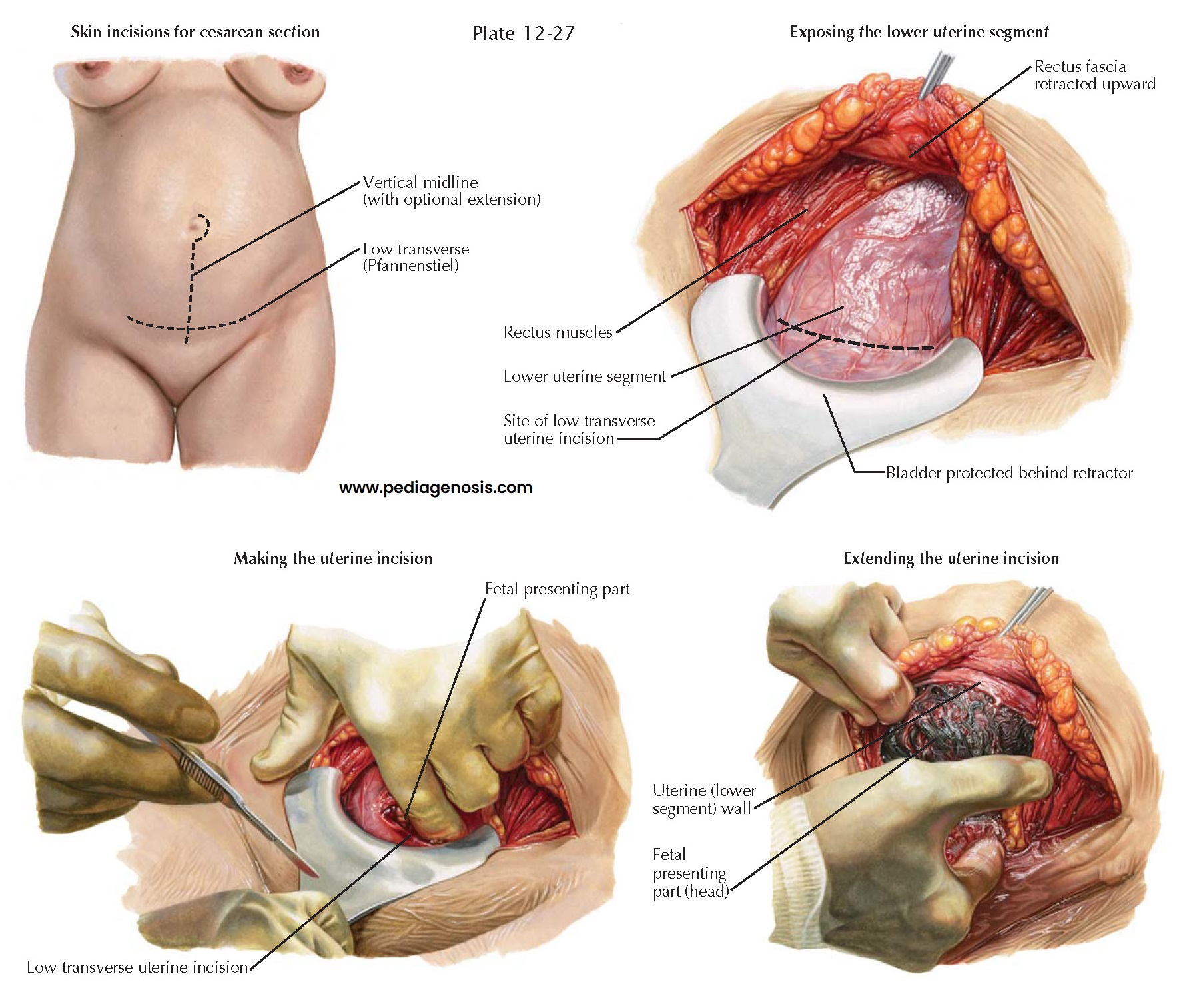 CESAREAN DELIVERY