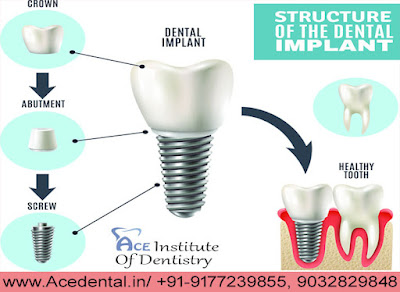 Dental Implant courses in India