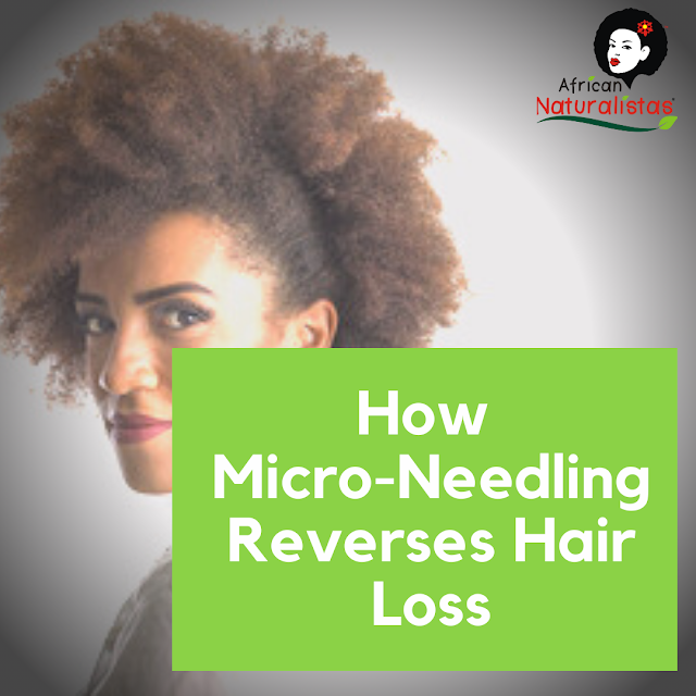 Microneedling for hair loss reversal