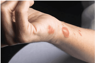 Saat kulit Anda tersiram air panas, usahakan untuk tidak panik. Perhatikan terlebih dulu apakah kulit Anda mengalami luka bakar ringan atau sangat parah.