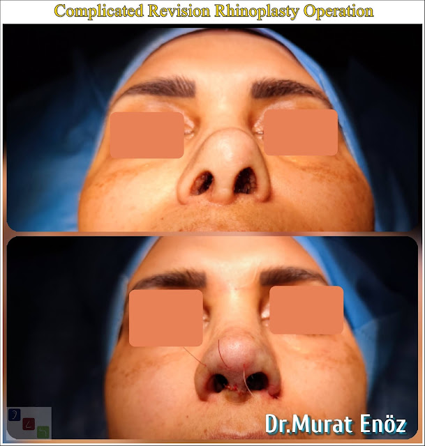 Revision rhinoplasty using rib cartilage,Secondary rhinoplasty,revision nose aesthetic surgery,Revision nose job in Istanbul