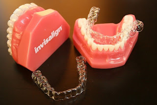 Quy trình niềng răng invisalign-1