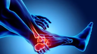 Change Lifestyle to prevent Arthritis Risk