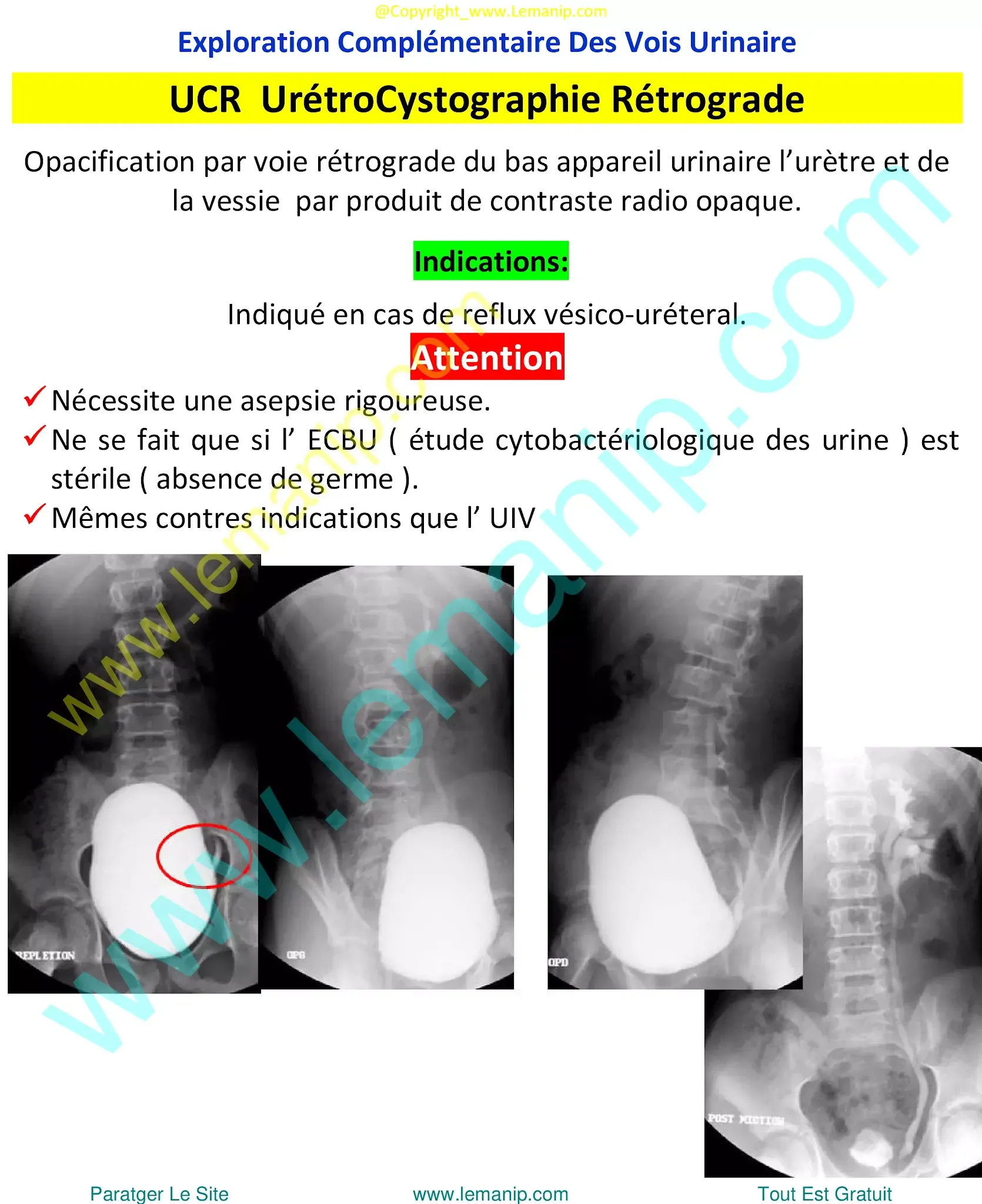 UCR  UrétroCystographie Rétrograde