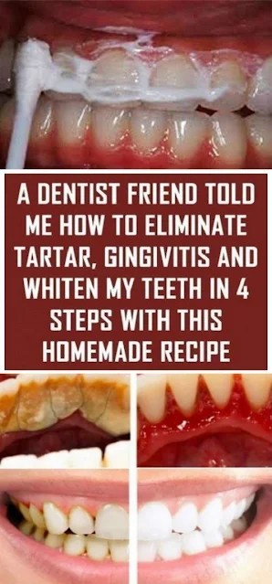 A Dentist Friend Told Me How To Eliminate Tartar, Gingivitis And Whiten My Teeth In 4 Steps With This Homemade Recipe