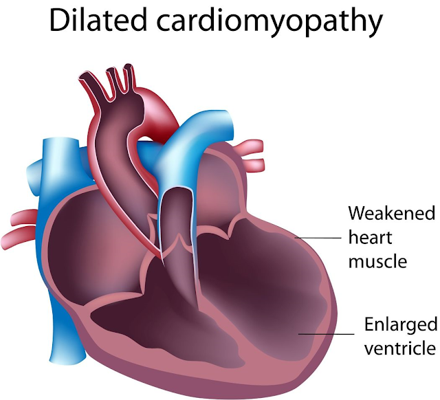 Dilated Cardiomyopathy Market