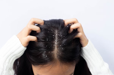 The Easiest Way to Overcome Dandruff Hair