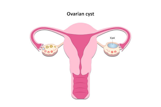 فهم أكياس المبيض: الأسباب والأعراض والعلاج Ovarian Cysts