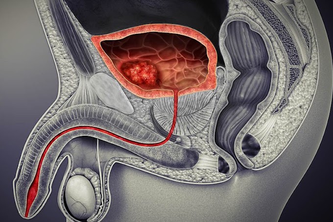 Bladder Cancer Market Demand Forecast, Challenges, Business Revenue, Sales Forecast, Key Players, Opportunities, Competition 2027