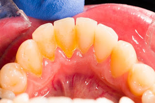 Các bước cạo vôi răng tại nha khoa-1