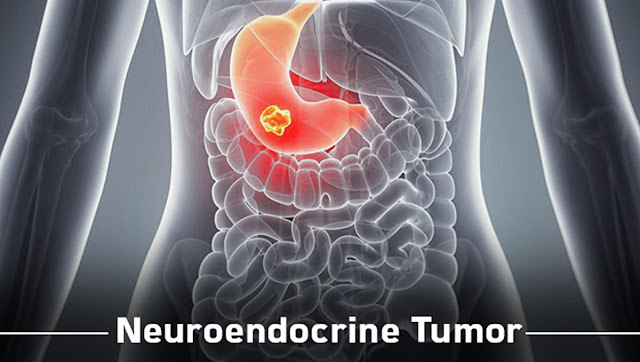 Neuroendocrine Tumor Treatment Market