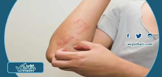علاج ظهور حبوب في الجسم مع حكة