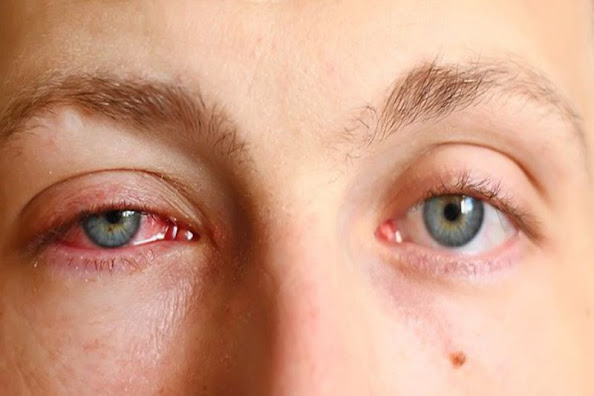 Mắt đỏ là dấu hiệu của bệnh gì?
