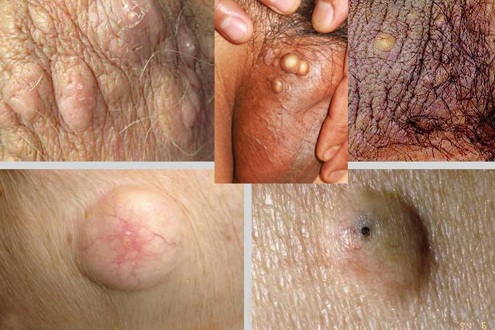 Sebaceous Cyst on Scrotum