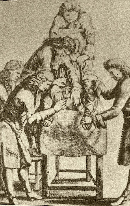 Cirugía en España en siglo XVI