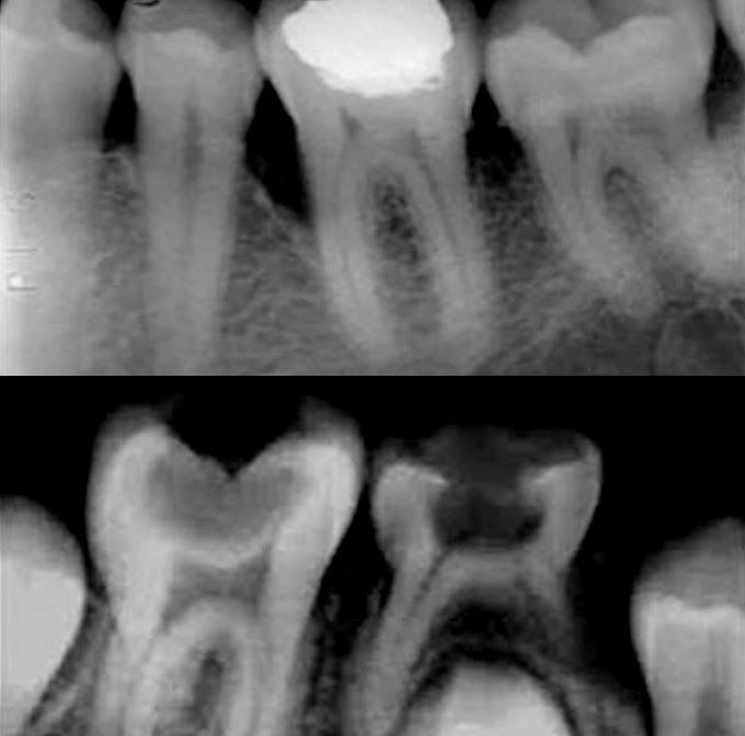 RADIOLOGÍA ORAL: Aspectos Radiográficos de la Caries Dental y Enfermedad Periodontal - Mg. Alonso Calderón Quispe