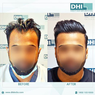 Hair Transplant in Chennai