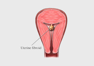 How To Prevent Fibroids from Growing