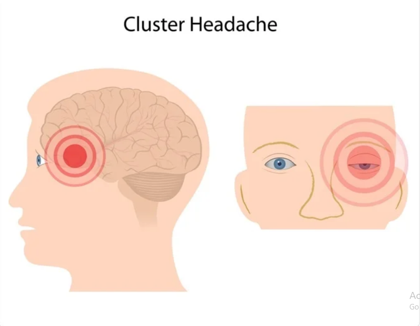 Best Treatment  & Signs and Symptoms of cluster headache in 2022