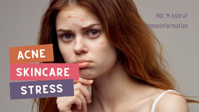 Acne Skin Care For Women Tips and Tricks - Stress Management