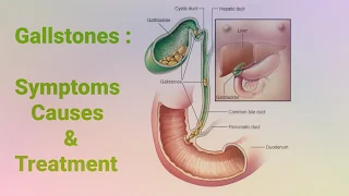 Gallstones