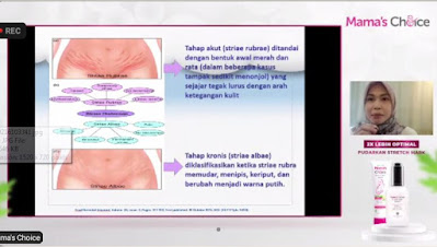 Ciri stretch mark saat hamil dan setelah melahirkan