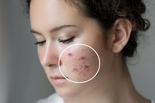 types of acne on face