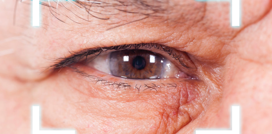 Glaucoma Surgery Cost in Hyderabad