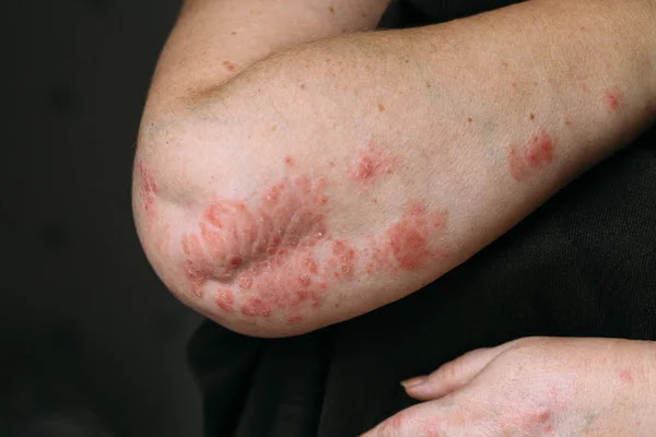 WHAT IS ATOPIC DERMATITIS? MAIN CAUSES, SYMPTOMS, WHAT IS DIFFERENCE BETWEENCAN  ECZMA AND ATOPIC DERMATITIS? CAN ATOPIC DERMATITIS GO AWAY? ATOPIC DERMATITIS IN HANDS, DIAGNOSIS, TREATMENT