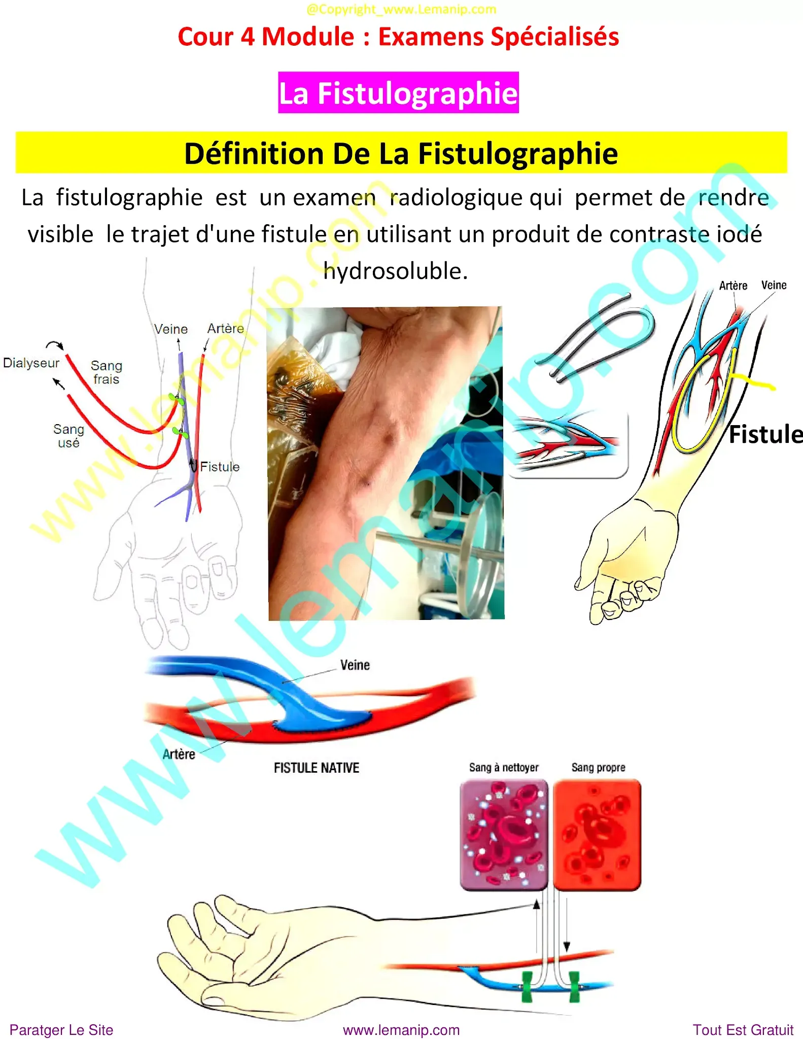 av fistula in leg for dialysis,perianal crohn's disease treatment,hemodialysis fistula,av fistula for hemodialysis,fistula in arm,av fistula,atrioventricular fistula,spinal fistula surgery,av fistula for dialysis,gum fistula