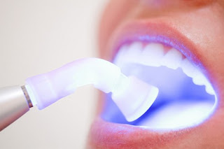 Quy trình trám răng thẩm mỹ-2