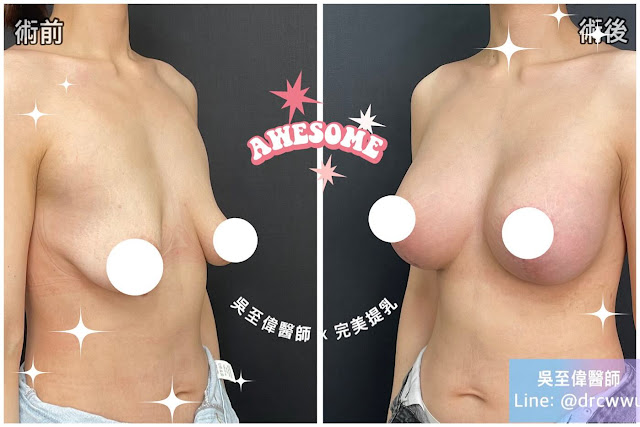 2023年十二月乳房整形 Breast Lift and Augmentation 案例分享