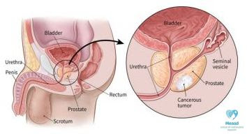 prostate, health, prostate health, cancer, supplements, men, prostate cancer, supplements prostate,