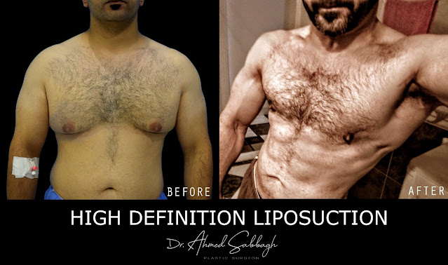 التثدي -  Dr. Ahmed El Sabbagh - Plastic Surgeon د.أحمد الصباغ - جراح تجميل