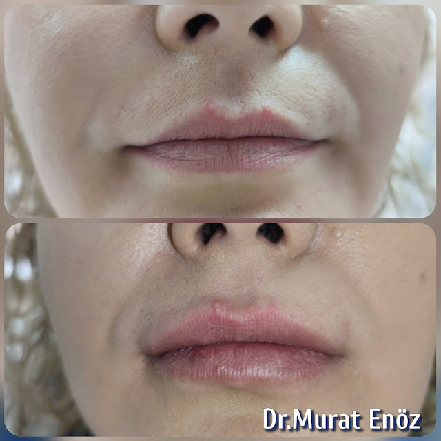 Lip Filler Injection - Augmentation in Istanbul