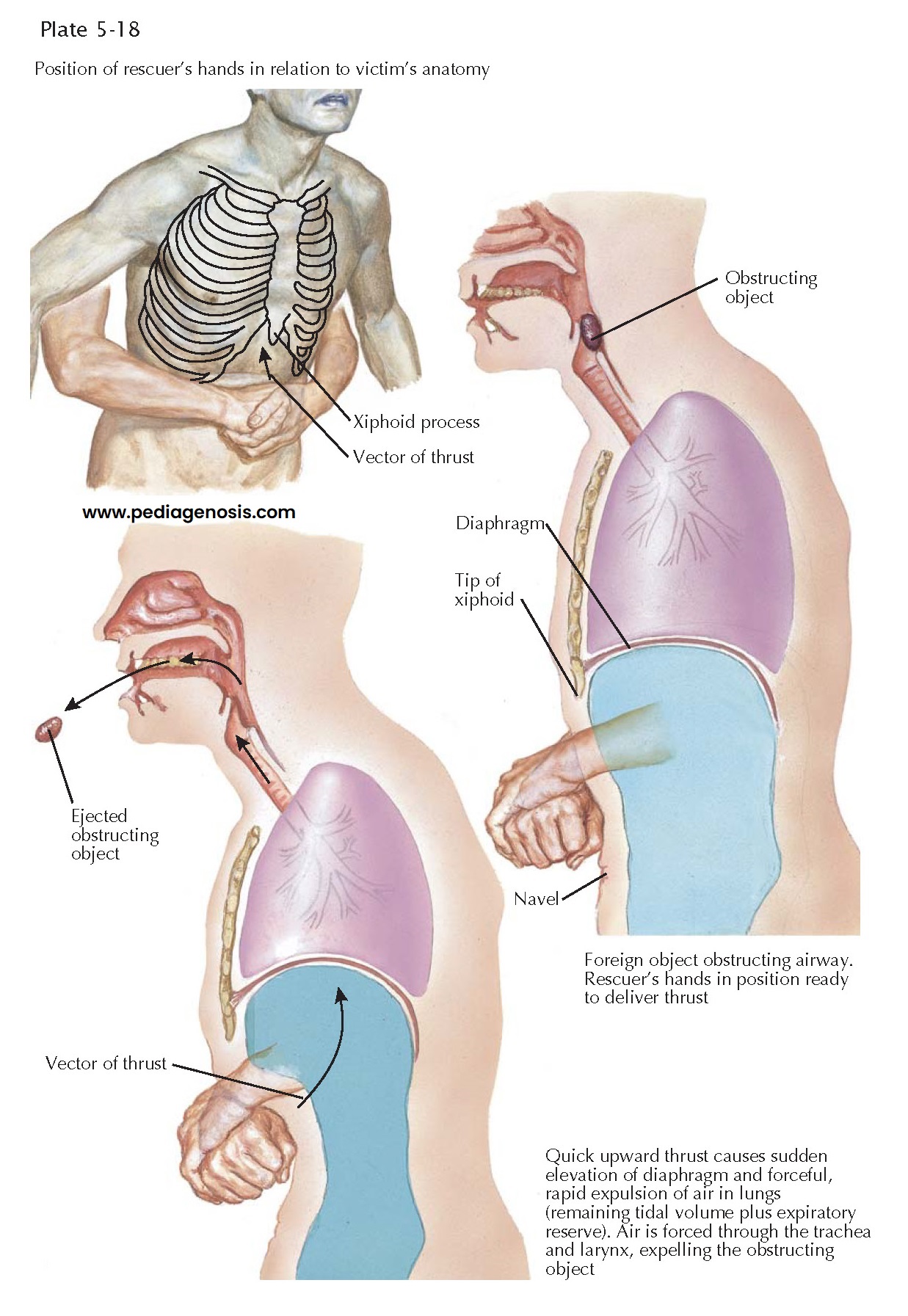 UPPER AIRWAY OBSTRUCTION AND THE HEIMLICH MANEUVER