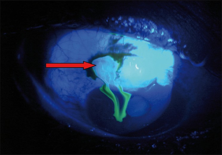 What is Seidel’s test in eye examination