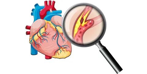 PERIPHERAL ARTERY CAUSES AND ITS TREATMENT