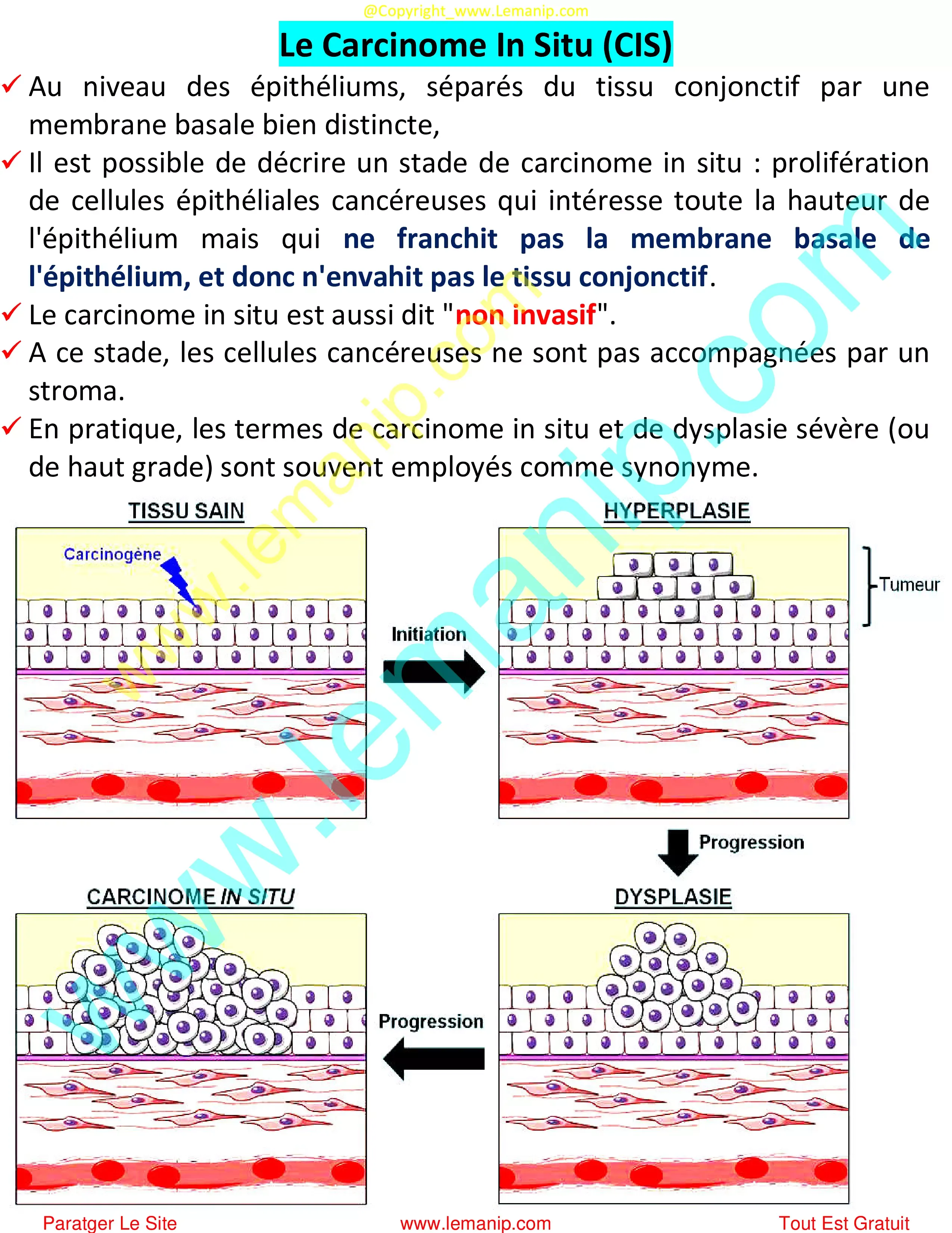 Le Carcinome In Situ (CIS)